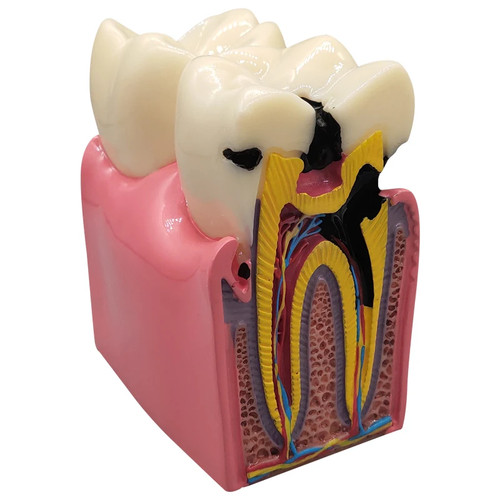 Modelo de caries dental 8 veces modelo de dientes de enfermedad para dentista modelo de demostración - Imagen 16 de 19
