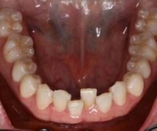 Relapse Orthodontic Treatment - Active Retainer Upper or Lower ~MADE in USA 