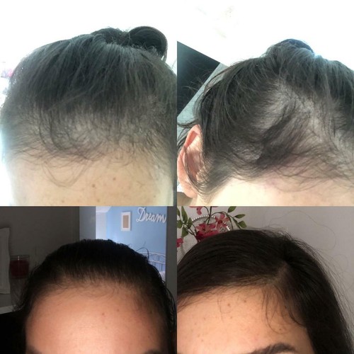 Organic Hair Growth and Anti Hair Loss Oil 30 Ml For Men & Women - Picture 4 of 13