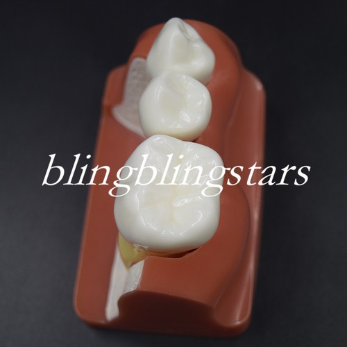 Dental Implant Demonstration Teeth Model Analysis Crown Bridge for Dentist 4 Tim - 第 7/9 張圖片