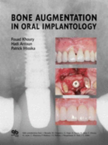 Bone Augmentation in Oral Implantology by Fouad Khoury (Hardcover) for ...