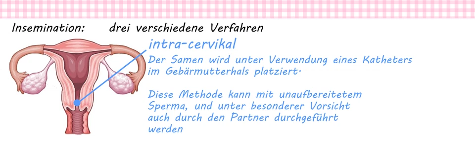 Kinderwunsch Inseminations-Kanüle Katheter, schwanger werden durch Insemination - Bild 2 von 4