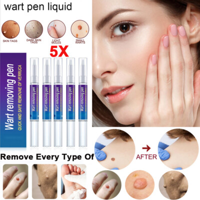 5pcs Wart Remover Pen Skin Tag Mole Remover Eliminate Foot Corn Warts Unisex