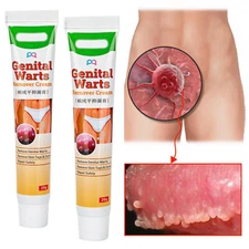 2pc Wart Remover Genital Ointment Herpe Cream Acuminatum Antibacterial Treatment