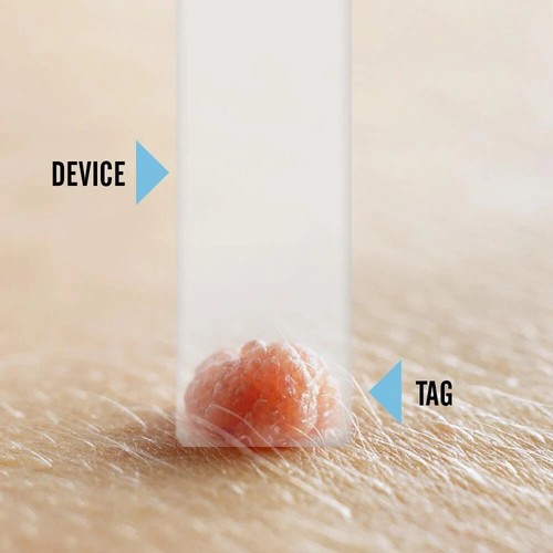 Tagcure PLUS - Skin Tag Removal Device DIY Removal kit Safe Permanent Treatment - 第 3/4 張圖片