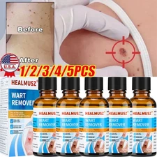 5/3X Wart Remover Liquid Skin Tag Mole Remover Eliminate Feet Corn Wart Removal