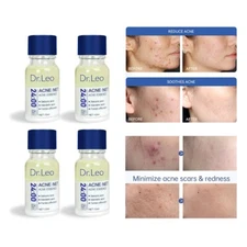 4X Dr.Leo Salicylic Acid Acne Treatment Drying Lotion Anti-Acne Blemishes 10 ml.