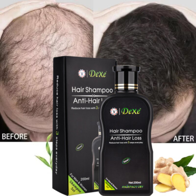 Hair Growth Shampoo Hair Regrowth Treatment Anti-Hair Loss Shampoo For Men&Women