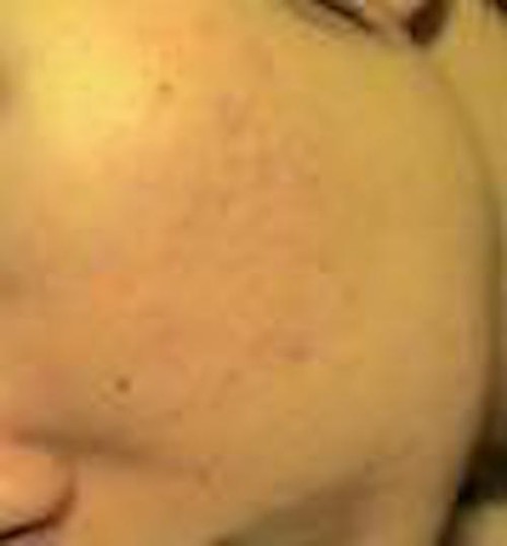 Cross Method Solution for Defined Pock Marks! Save $$$$ - 第 6/6 張圖片