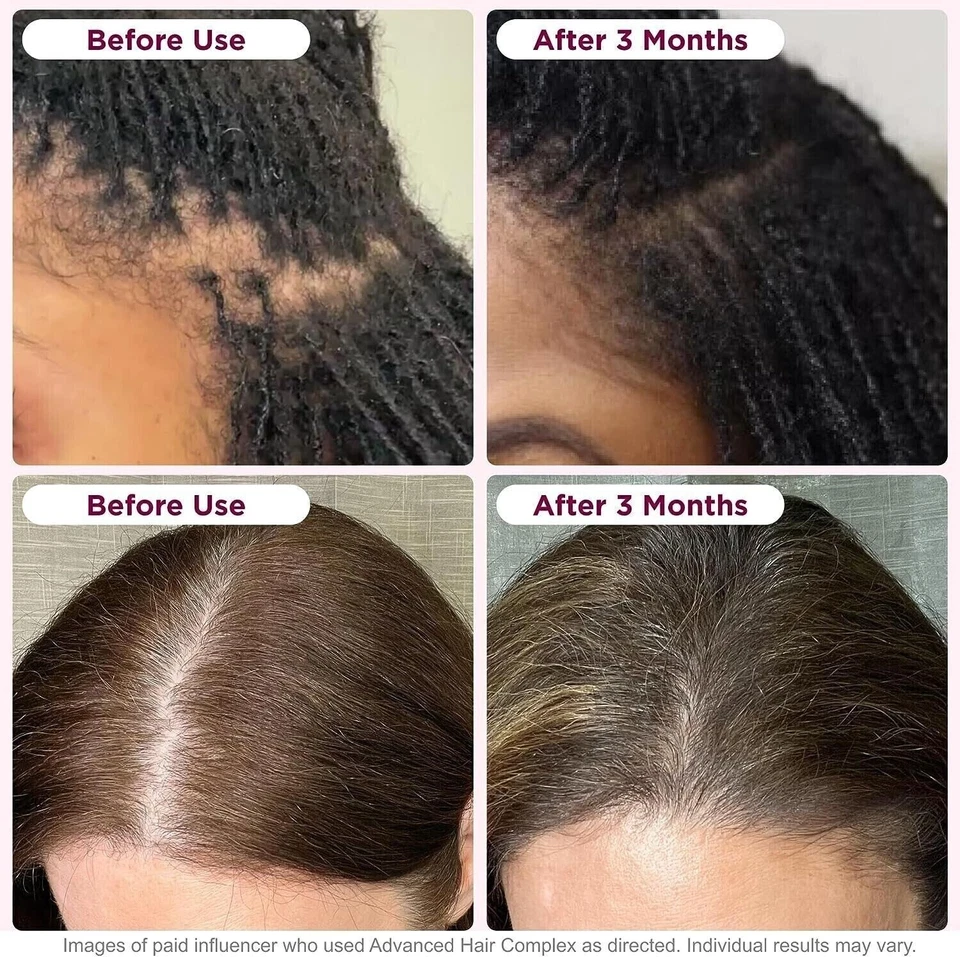 DHT-Blocker Haarwachstumsergänzung hochpotentes Biotin & Sägepalme 60 Kapseln - Bild 4 von 4