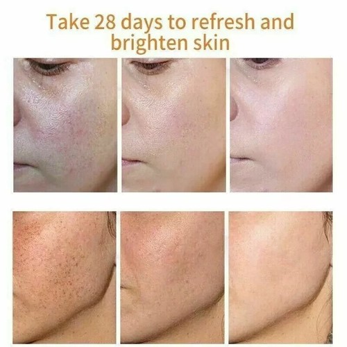 New Strong Removal Melasma Whitening Cream Sunburn Spots Pigment Freckle Speckle - Picture 3 of 5