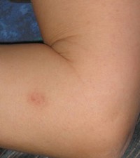 Helps make your Pet Ulcers go away from Spider Bites and Tick bites