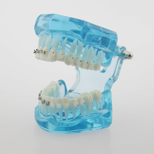 Dental Orthodontic Teeth Study Model with Metal Ceramic Bracket Braces 3003 - Picture 27 of 33
