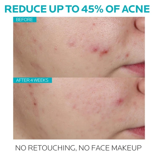 La Roche Posay Effaclar Ultra Concentrated Serum - 30ml US - Picture 2 of 5