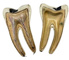 Vintage Dentists 2 piece tooth model display with cavity