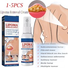 1-5PC Lipomheilung Reduction Spray,Instant LumpFree Lipoma Removal Spray USA Hot