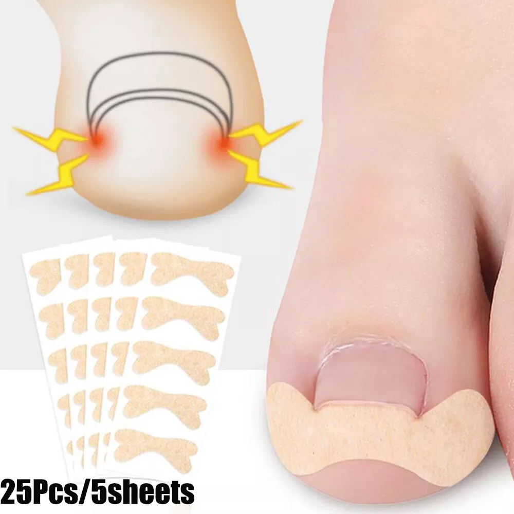Ingrown Toenail Correction Tool Toenail Treatment Corrector Stickers UK eBay Ingrown Toenail Removal Kit 100 PCS Professional Toe Nail Treatment Tool Ingrown Toenail Corrector Toenail Corrector Patch and Toe Protectors for