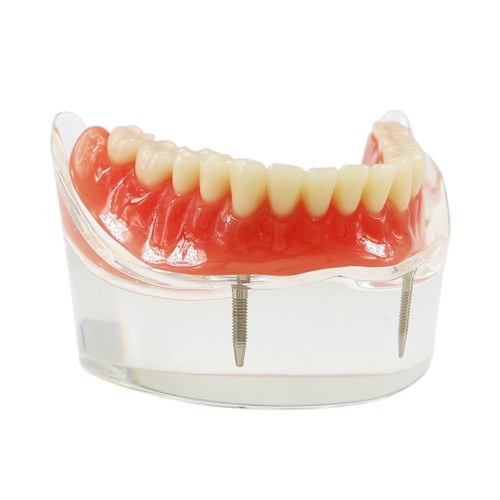 Demo modello denti Typodont restauro overdenture dentale con 2 impianti modello - Foto 8 di 12