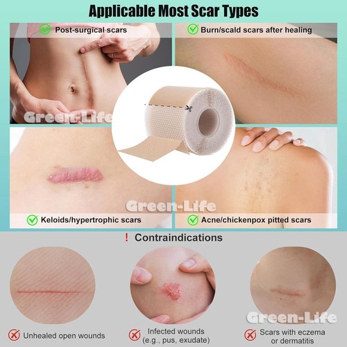 Silicone Scar Sheets & Tape Roll 1.5/3/5M | Scar Removal, Keloid, Acne, Marks - Picture 10 of 20