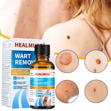Wart Remover Liquid Skin Tag Mole Remover Eliminate Feet Corn Wart Remove Liquid