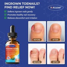 Ingrown Toenail Relief: Ingrown Toenail Tool at Home.Ingrown Toenail Remover..