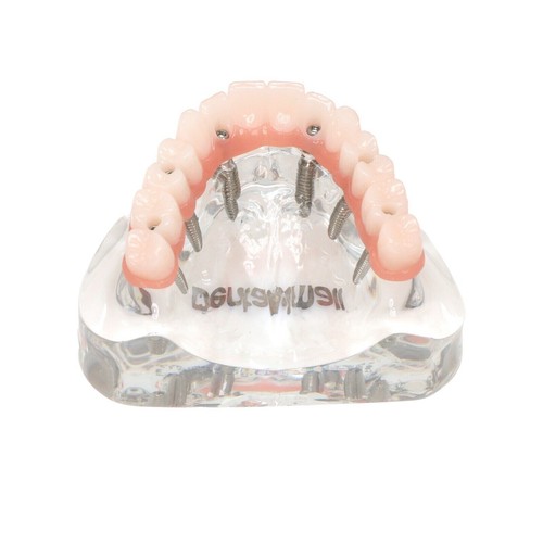 Implante dental todo en 4/6 sobredentadura modelo mandíbula superior restauración 4/6 tornillos - Imagen 16 de 26