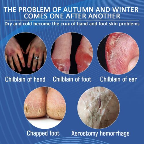30 ml Chilblain Cream Anti-cracking Frostbite Moisturiser Deep Nourishing - Picture 3 of 12