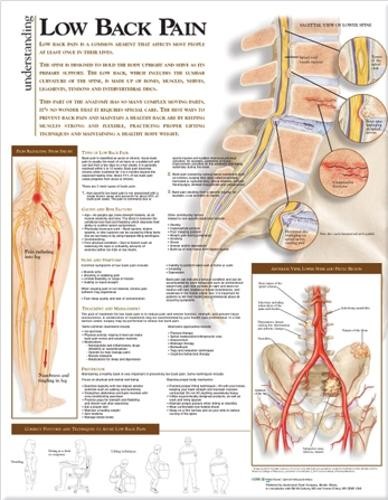 Understanding Low Back Pain Anatomical Chart (Poster)
