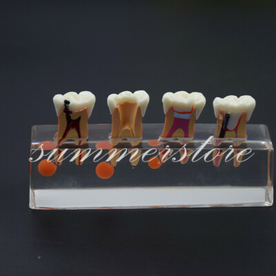 1 Set Dental Endodontic Root Canal 4 Stage Treatment Demonstrates Model #4018 01