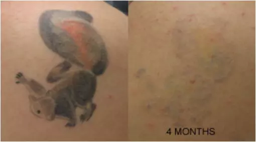 Tattoo-Off Tattoo Removal System 1 Month Supply