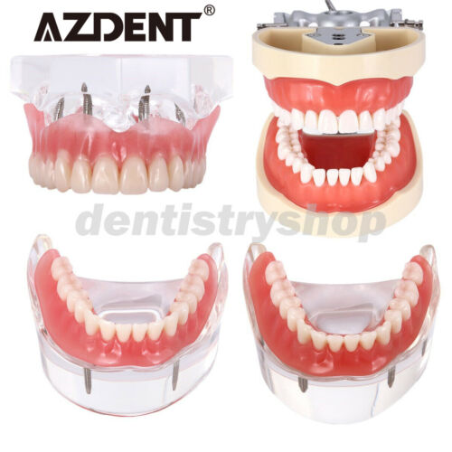 <!--F#f_0-->AZDENT Dental Typodont Model /Implant Denture Restoration Model<!--F/-->