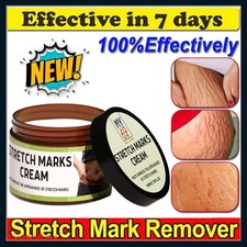 Scar Removal Cream for Surgical Scars Burns Stretch Marks Acne Spots Repair NEW