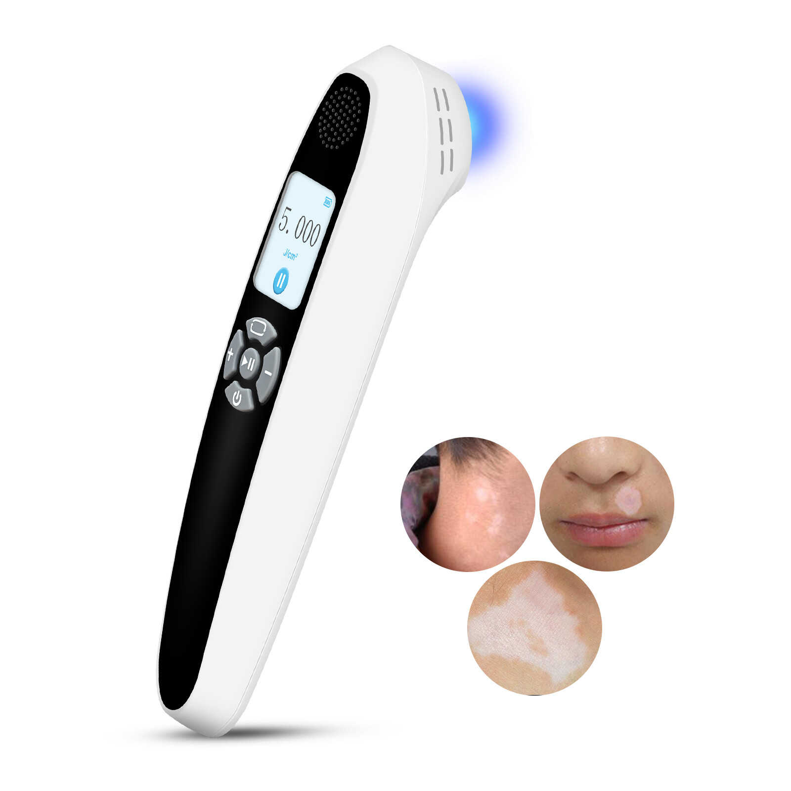 ALTRA Lampada UVB per Viso Corpo Lunghezza d'Onda 308nm Intensità Regolabile 0 5J cm²