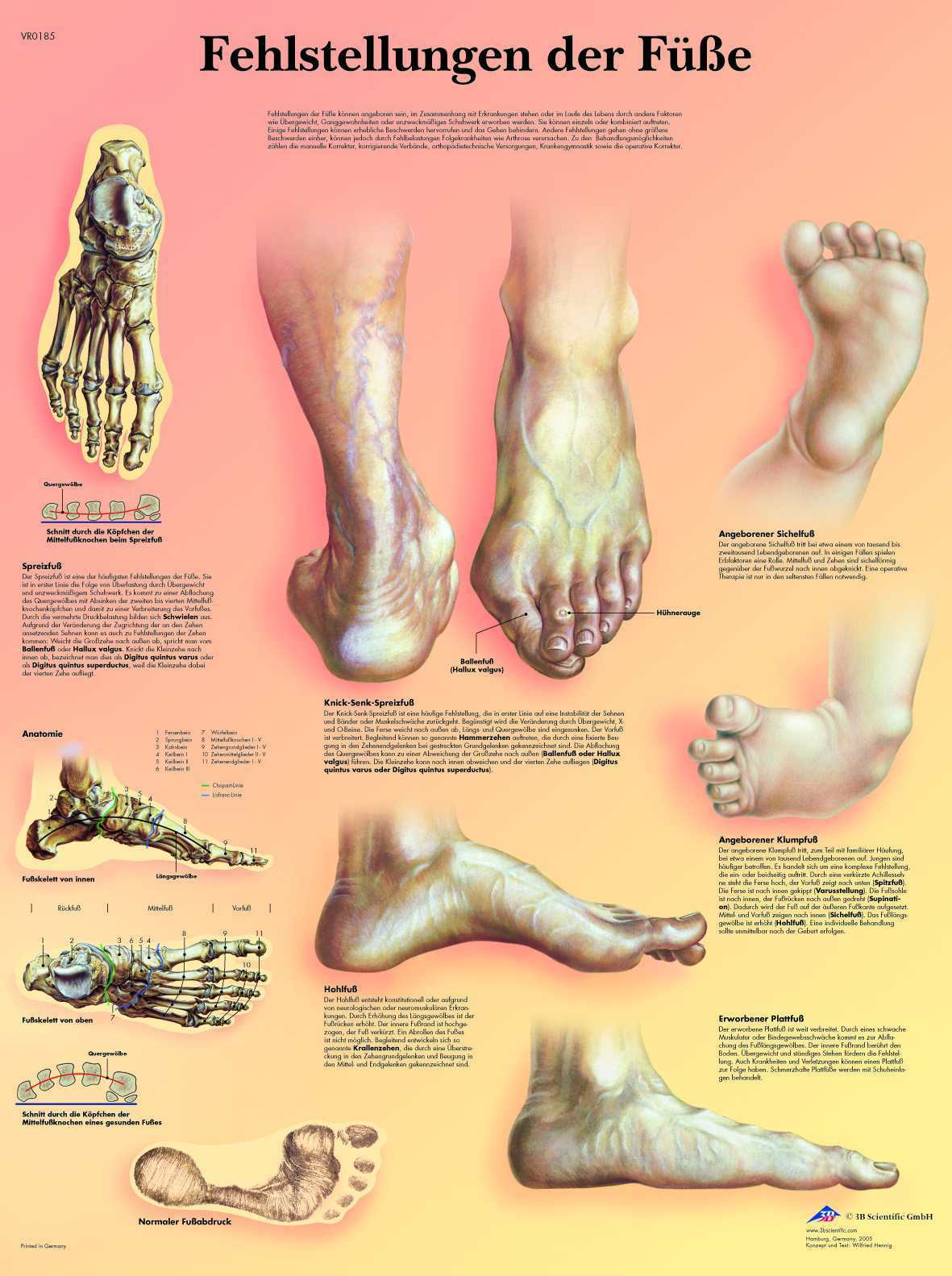 Fehlstellungen der Füsse Lehrtafel Anatomie 50 x 67 cm Poster
