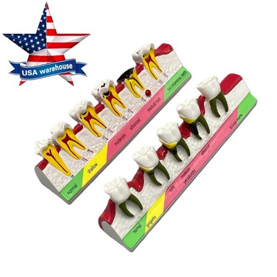 Dental Teeth Dentoform Models Caries Disease Periodontal Endodontics Teach Model