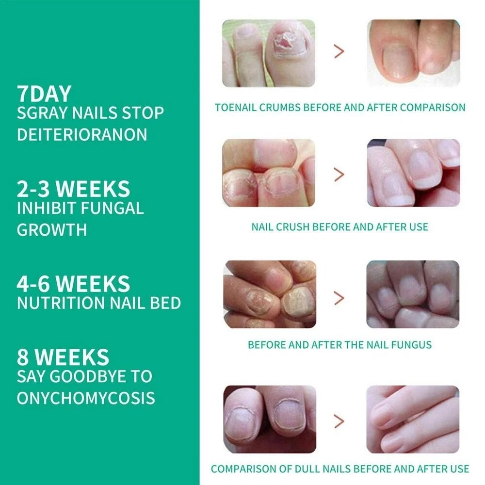 Top more than 144 diy nail growth recipe latest ceg.edu.vn