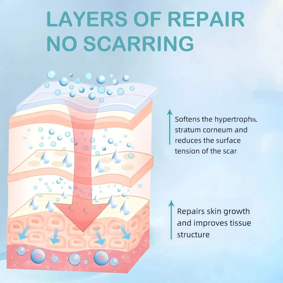 Acne Scar Treatment for Stretch Marks, Surgical, Burns & Injuries Scars Removal - Image 4 of 4
