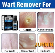Premium Wart Remover Liquid 17 Salicylic Acid Plantar Common Corn Callus Remova