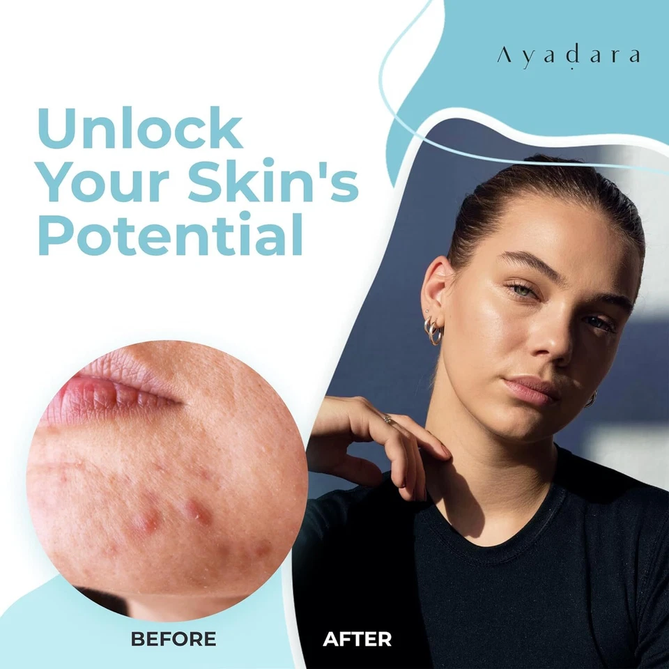 Ayadara Cystic Hormonal & Severe Acne Charcoal Face Wash with Sulfur, 425 Uses - Image 2 of 4