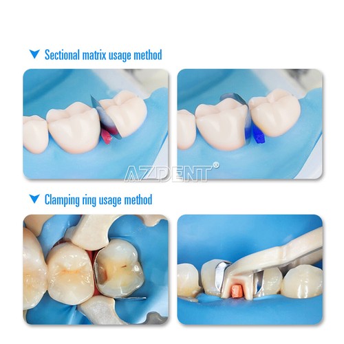 2Boxes AZDENT Dental Sectional Contoured Metal Bands Matrices Matrix Ring Refill - Picture 6 of 12