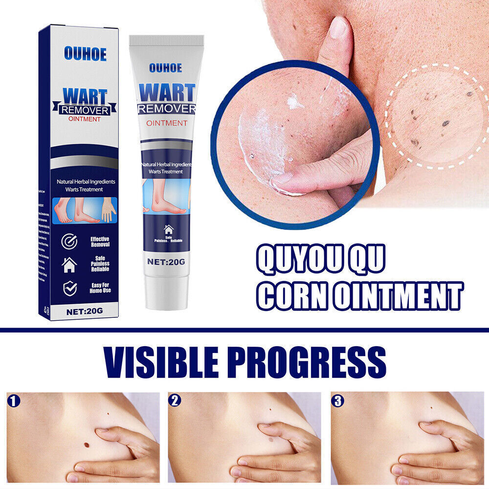Warts Remover Ointment Body Facial Flat Wart Cream Treatments Skin Tag