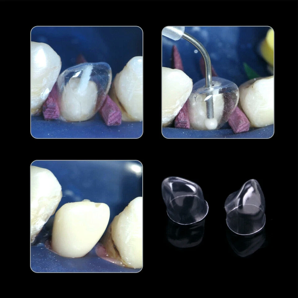 Dental Preformed Crown Resin Temporary Pre-corona Transparent Anterior Molar - Image 4 of 4