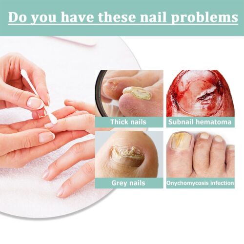 4ml Nail Care Pen Kosmetische Nagelpilz Behandlung, schnell intensive (3 Jahre) - Bild 14 von 15