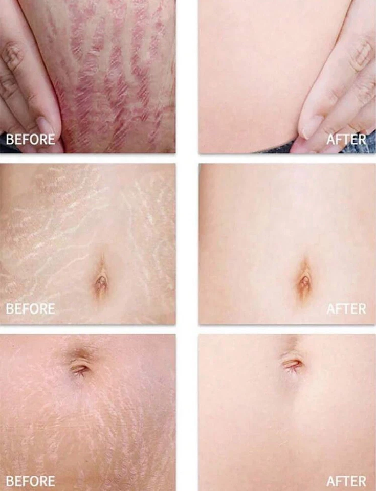 estrías hidratar, suavizar, reafirmar, reparar Foto 2 de 4