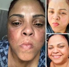 Fade Brightening and Clearing Cream  Reduces Discoloration Post-Blemish Marks