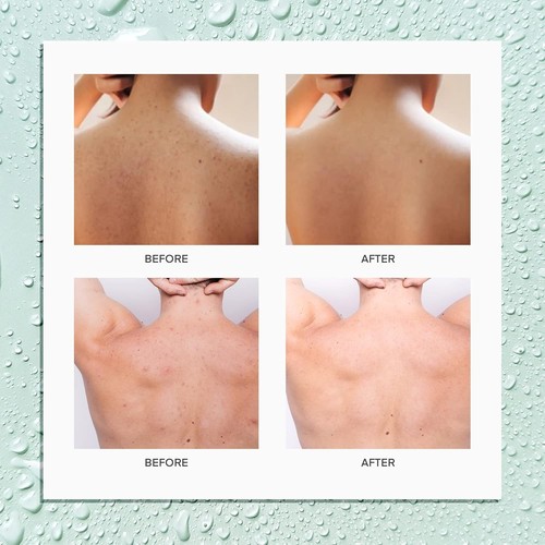 Body and Back Acne Treatment Spray: 2% Salicylic Acid & Tea Tree Oil Bacne Spray - Picture 4 of 6