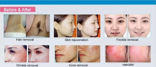 OPT SHR IPL hair removal machine elight ipl laser skin rejuvenation Spa salon - Picture 5 of 6