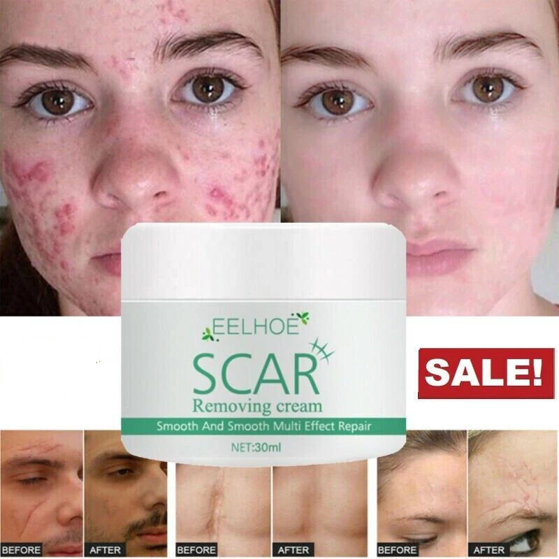 Acne Scar Spots Removal Cream Burns Stretch Marks Repair Gel