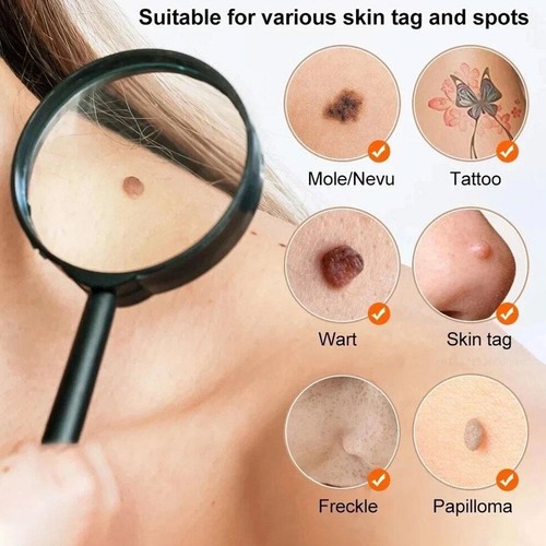Plasma Pen, Skin Tag Remover, Mole Removal Wart Spots Dark Dpot Black Dot GXS - Picture 7 of 11