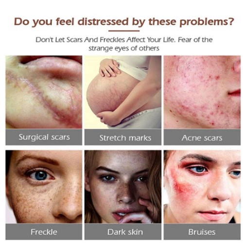 Dermatix Ultra Advanced Scar Gel 15g -Efficient & Regain Beauty - EXP 2030 New - Picture 4 of 12